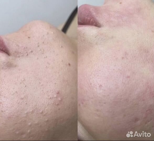 Чистка лица, пилинги, биоревитализация