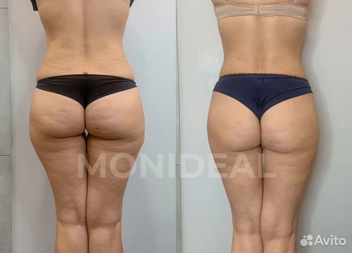 Коррекция фигуры безоперационная липосакция