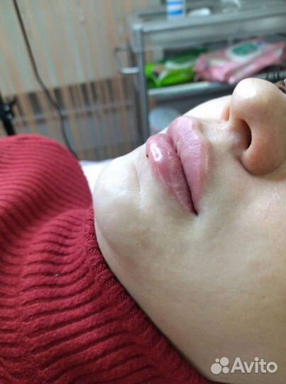 Увеличение губ