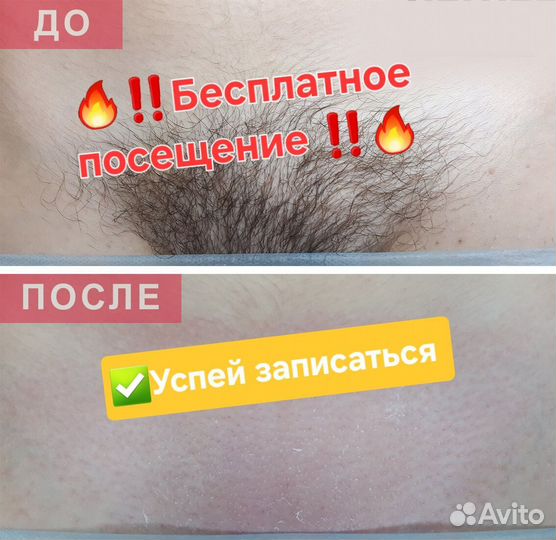 Лазерная эпиляция