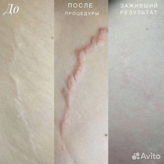 Камуфляж растяжек, удаление шрамов