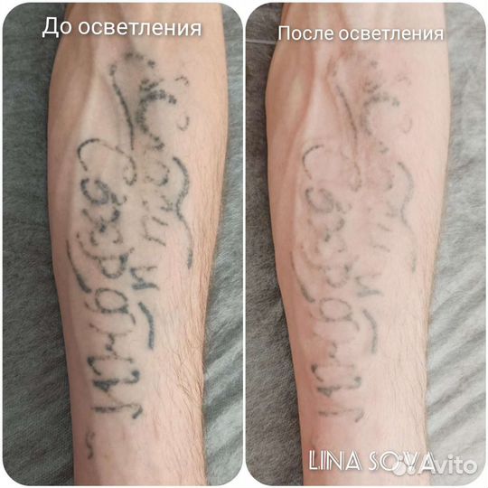Осветление и удаление татуажа и татуировок