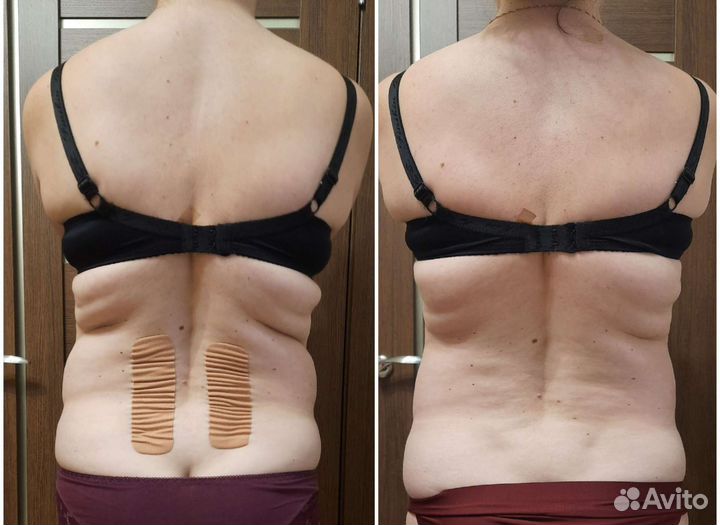 Тейпирование