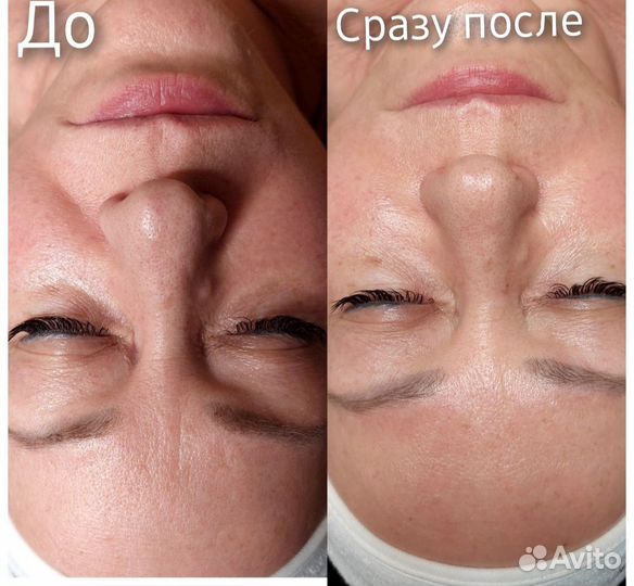 Холодная плазма Тольятти