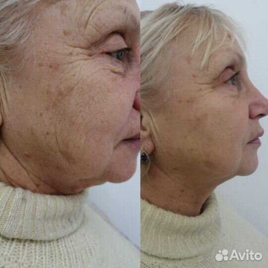 Смас лифтинг лица