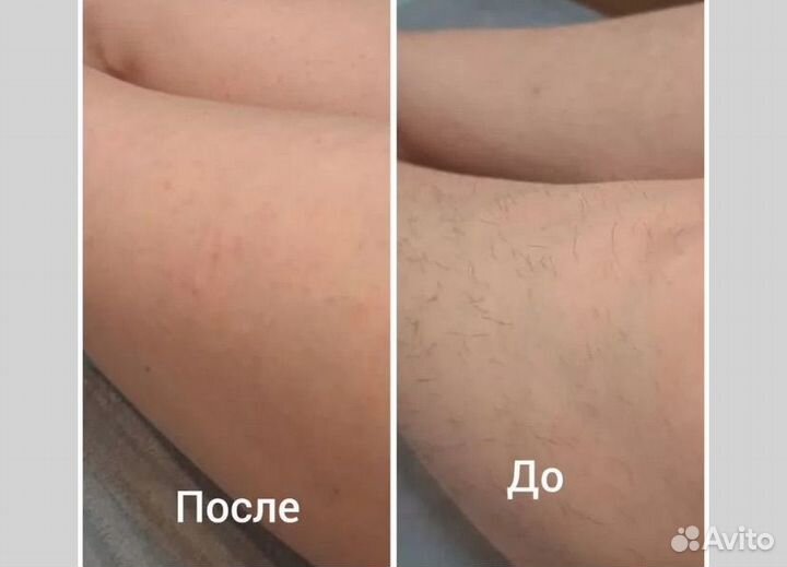 Бесплатно шугаринг