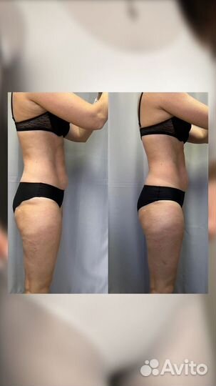 Lpg массаж, ручной массаж, кавитация, вибромассаж