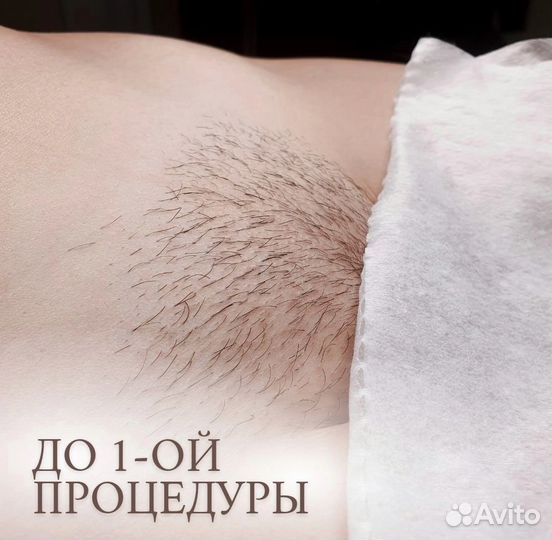 Шугаринг в Динской
