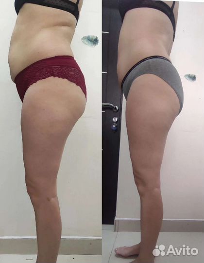 Антицеллюлитный массаж