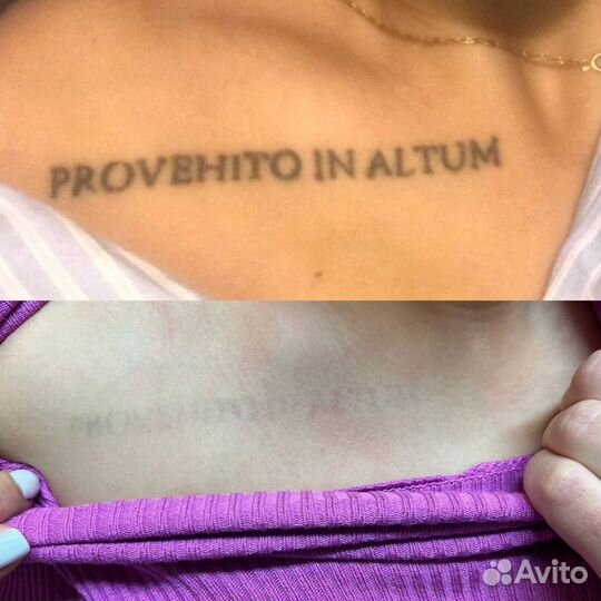 Удаление тату Лучший Лазер в Иваново