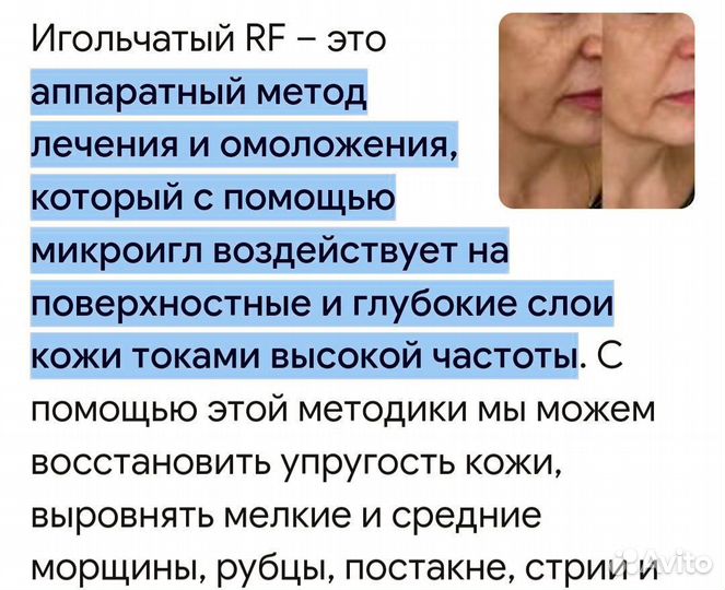 Игольчатый РФ лифтинг