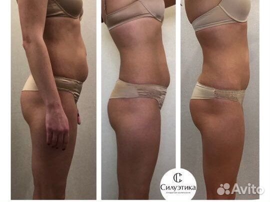 Антицеллюлитный, лимфодренажный массаж