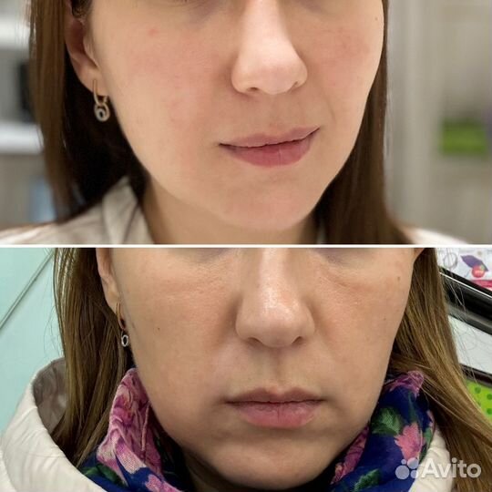 Липолитики по лицу