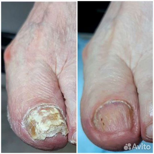 Подолог,педикюр,вросший ноготь
