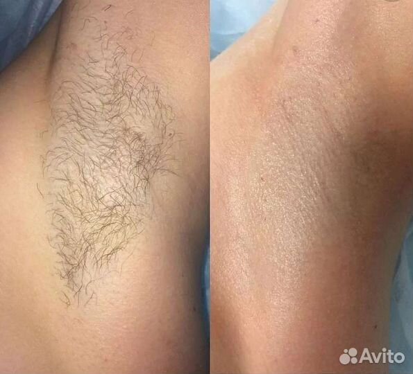 Электроэпиляция: ягодицы