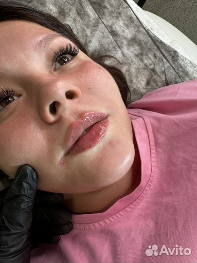 Увеличение губ филлером