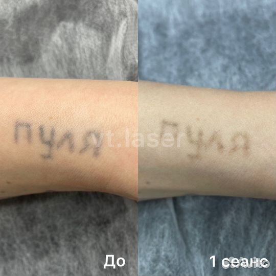 Лазерное удаление тату и татуажа