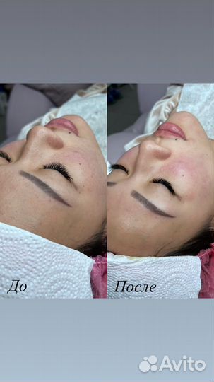 Чистка лица