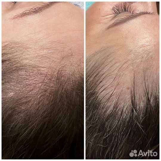 Трихопигментация по методу SMP