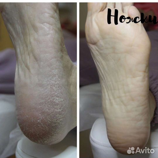 Лечебный педикюр