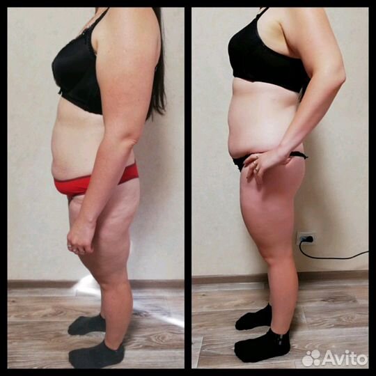 Вакуумный массаж. Кавитация. РФ лифтинг