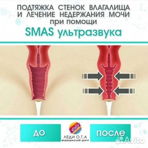 Ультразвуковое смас интимное омоложение
