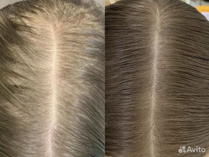 Лечение волос / пилинг / трихолог