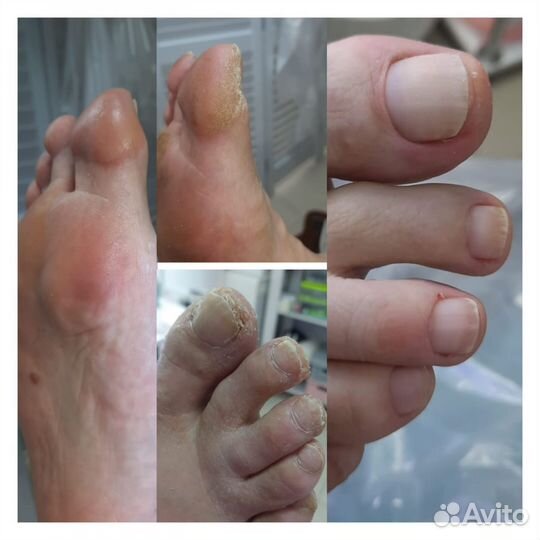 Титановая нить педикюр