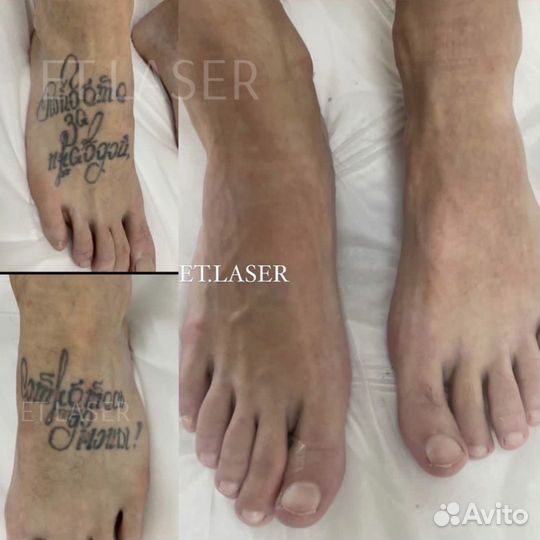 Удалить татуировку в Москве