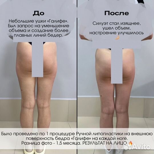 Массаж LPG / Vela Shape