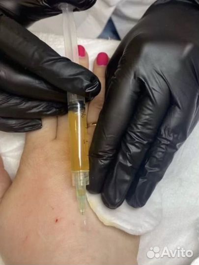 Плазмолифтинг