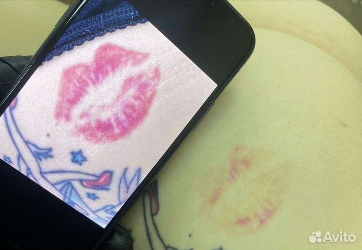 Лазерное удаление тату