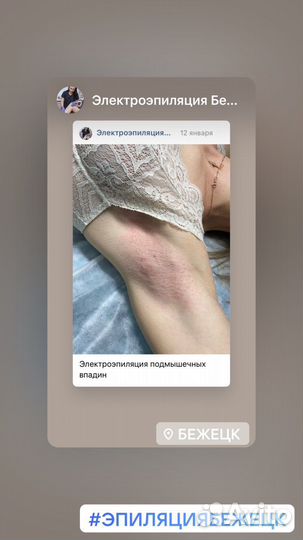 Удаление волос навсегда