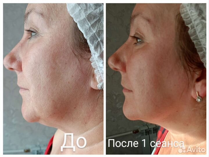 Массаж лица, безоперационное омоложение