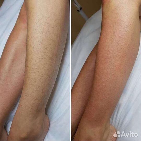 Лазерная эпиляция