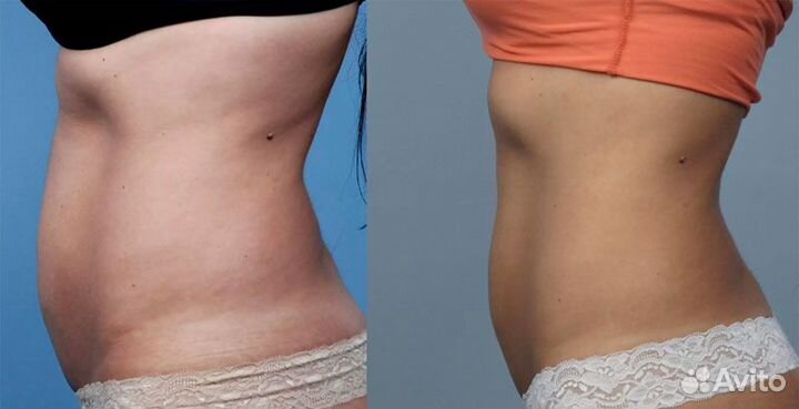 Криолиполиз, коррекция фигуры