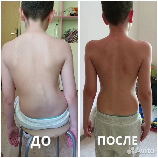 Акупрессура подзатылочных мышц