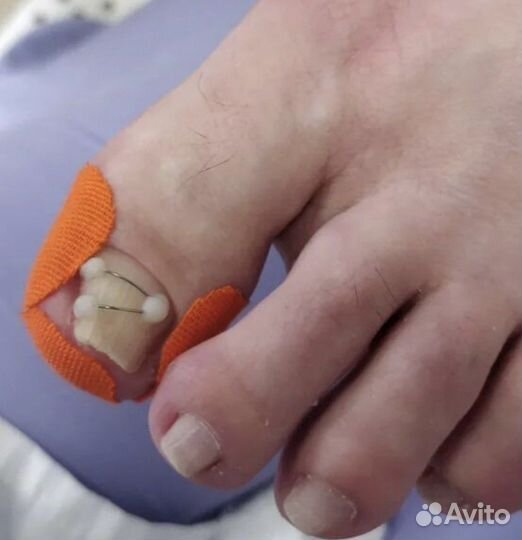 Педикюр медицинский.Титановые нити.Подолог