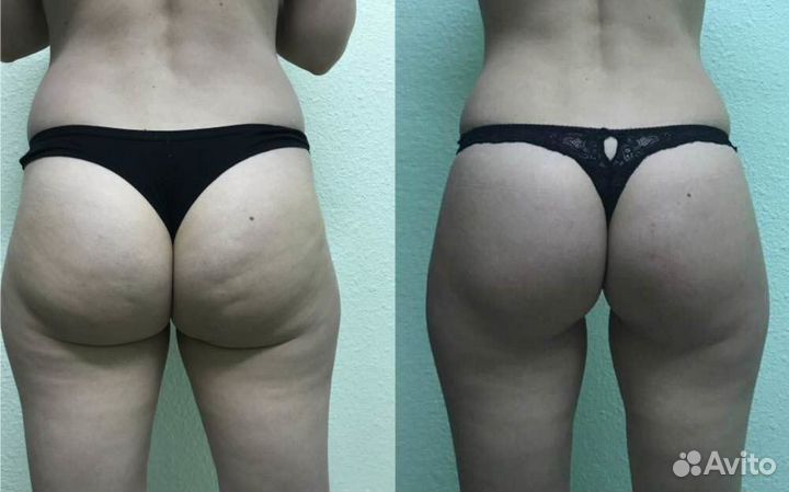 LPG массаж,вакум-массаж,кавитация, РФ - лифтинг