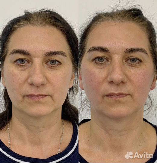 Массаж лица