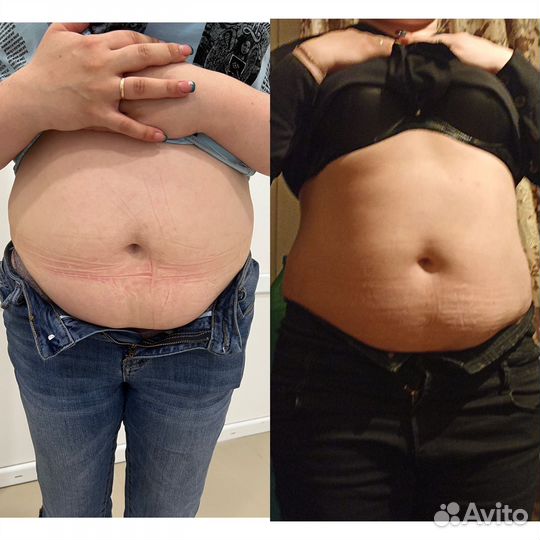 Криолиполиз (Похудение)