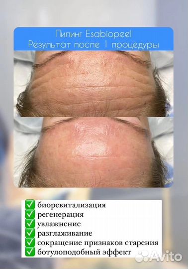 Итальянский пилинг