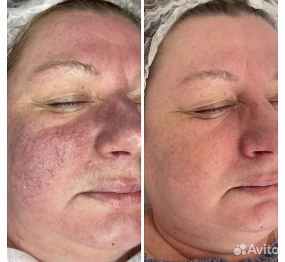 Фотоомоложение лица на IPL lumecca