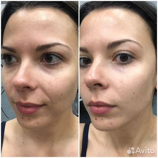 Сплэш-лифтинг массаж лица