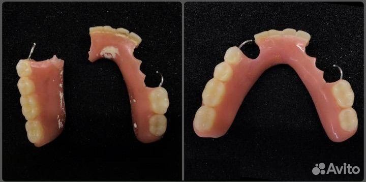 Изготовление и ремонт сьемных протезов