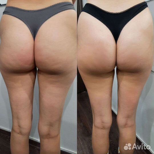 Лечебный и антицеллюлитный массаж