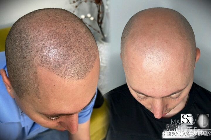 Трихопигментация SMP