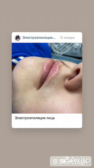 Удаление волос навсегда