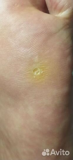 Мастер педикюра, подолог.Трещины,мозоли