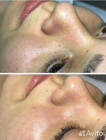 Карбоновый пилинг